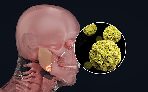 腮腺感染人体腮腺疾病设计图片