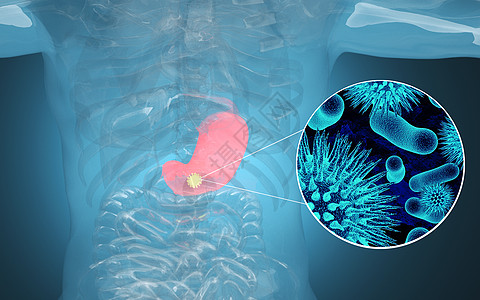 炎症人体胃部疾病设计图片
