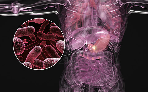 人体胃部疾病场景图片