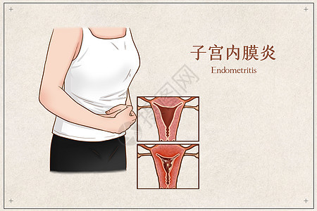 子宫内膜炎医疗插画图片