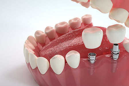 牙齿修复医美种植牙设计图片