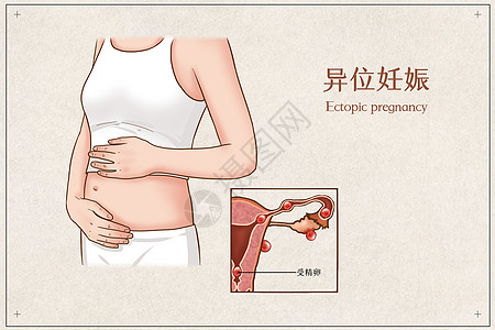异位妊娠医疗插画图片