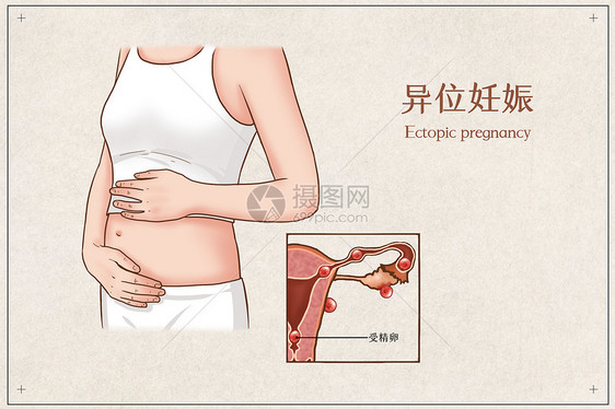 异位妊娠医疗插画图片