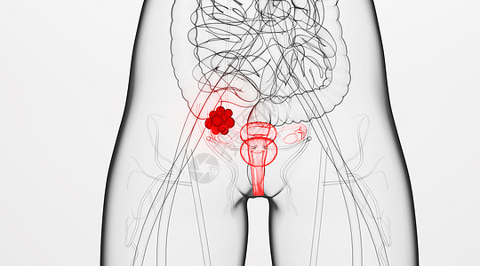 人体卵巢病变场景图片