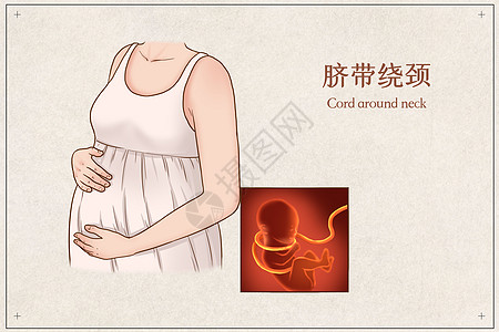 孕妇生病脐带绕颈医疗插画插画