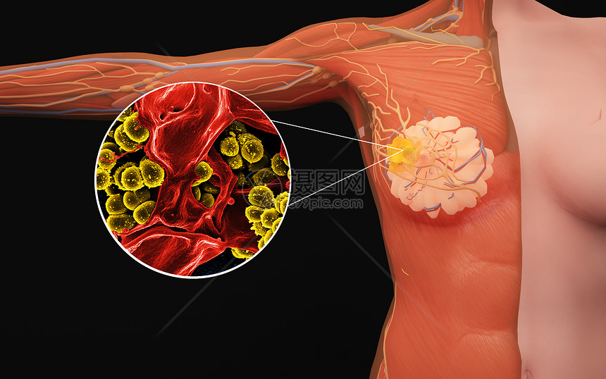 人体女性乳腺病变图片