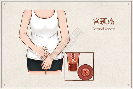 医学PPT宫颈癌医疗插画插画