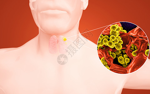 人体甲状腺感染图片