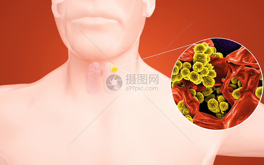 人体甲状腺感染图片