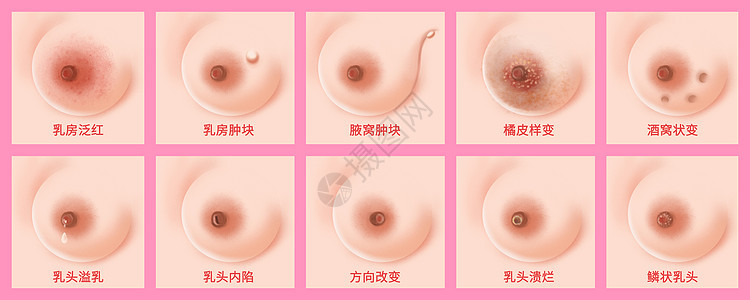 乳腺癌早期症状医疗插画图片