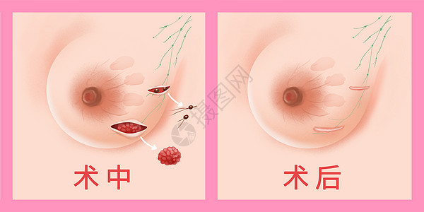 乳腺癌保乳手术医疗插画图片