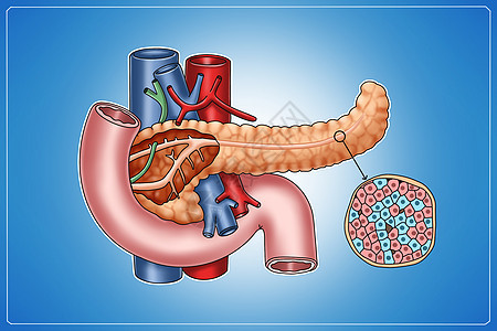 糖尿病胰岛医疗插画图片