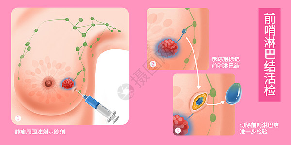 重大疾病乳腺癌前哨淋巴结活检医疗插画插画