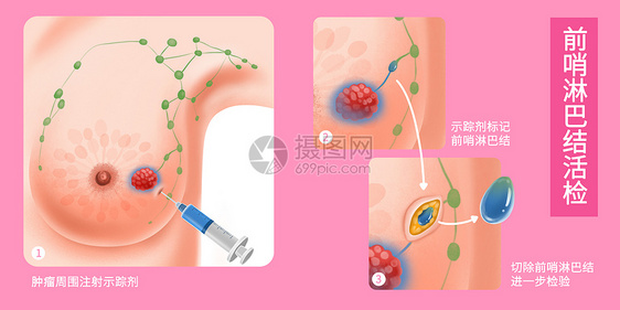 乳腺癌前哨淋巴结活检医疗插画图片