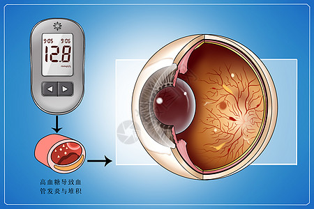 眼球糖尿病并发症视网膜病变医疗插画插画