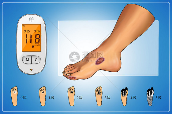 糖尿病并发症糖尿病足医疗插画图片