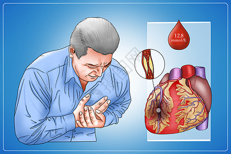 糖尿病并发症心脏病医疗插画图片