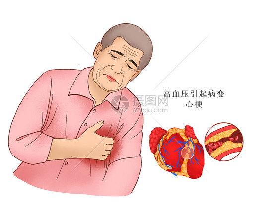 高血压心梗医疗插画图片