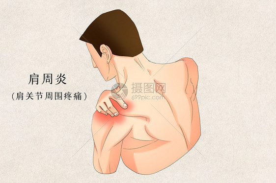 肩周炎肩关节周围疼痛症状二图片