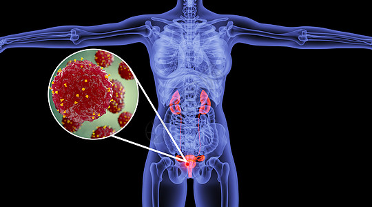 生殖系统膀胱炎症设计图片