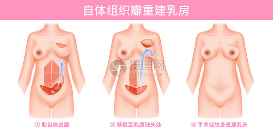 乳腺癌自体组织瓣重建乳房医疗插画图片