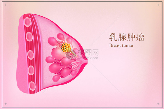 乳腺肿瘤医疗插画图片