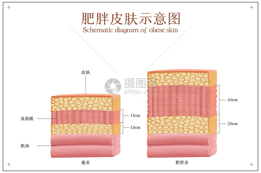 皮肤肥胖示意图图片