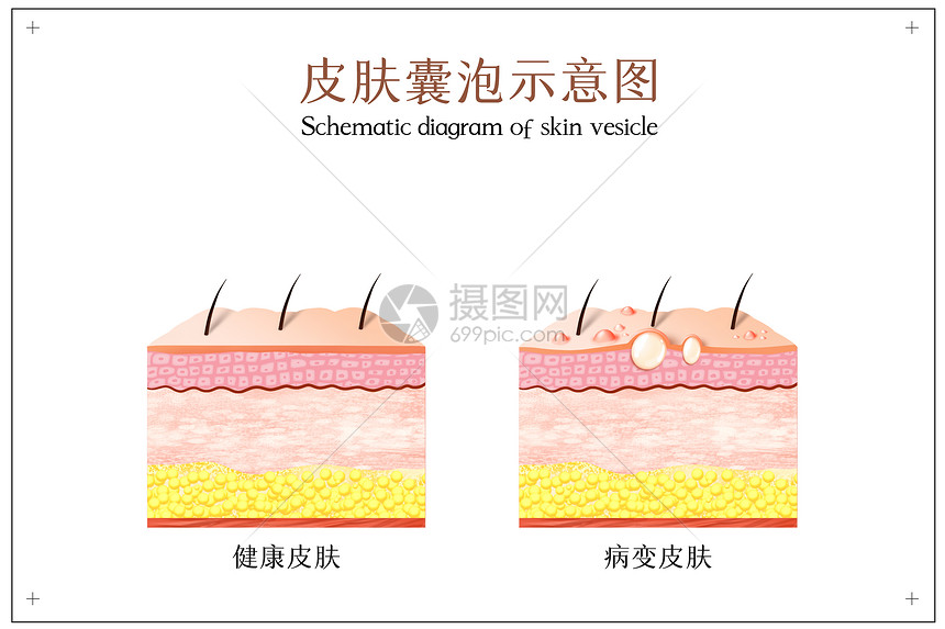 皮肤病变之皮肤囊泡示意图图片