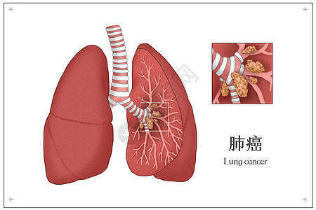 肺癌肺部病变医疗插画图片