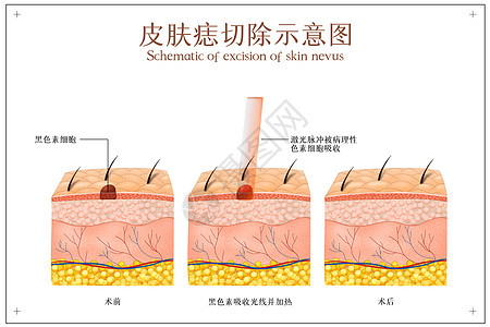 面部美容去除黑痣示意图图片