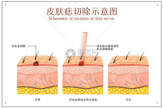 面部美容去除黑痣示意图图片