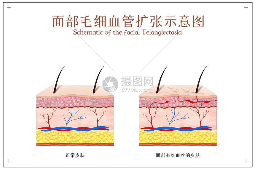 面部红血丝示意图图片