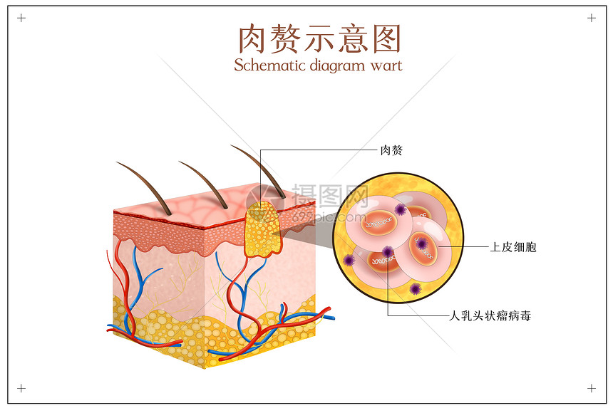 皮肤病变之肉赘示意图图片