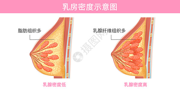 丰胸模特乳腺密度示意图医疗插画插画