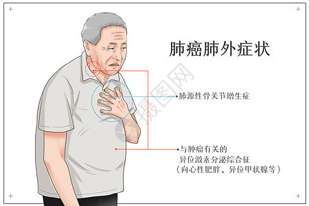 肺癌肺外症状医疗插画图片