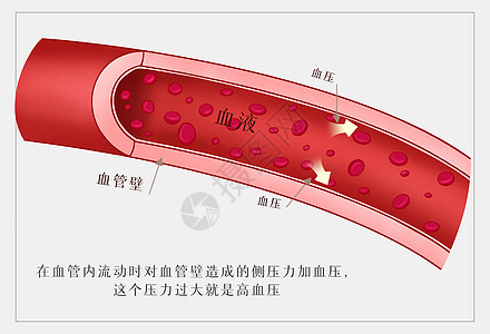 大血管什么是高血压医疗插画插画