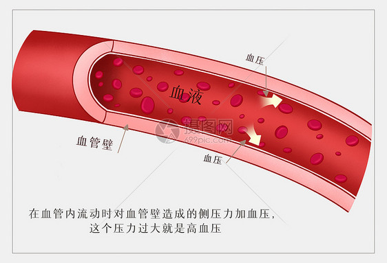 什么是高血压医疗插画图片