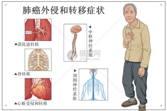 肺癌外侵和转移症状医疗插画图片