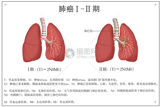 肺癌发展阶段医疗插画图片