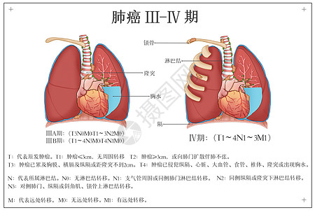 临床诊断肺癌发展阶段医疗插画插画