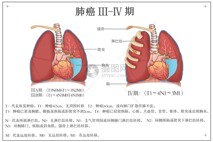 肺癌发展阶段医疗插画插画图片下载 正版图片 摄图网