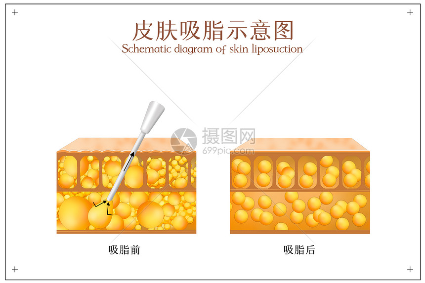 吸脂后皮肤对比示意图图片