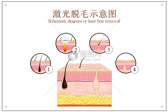 激光脱毛示意图图片