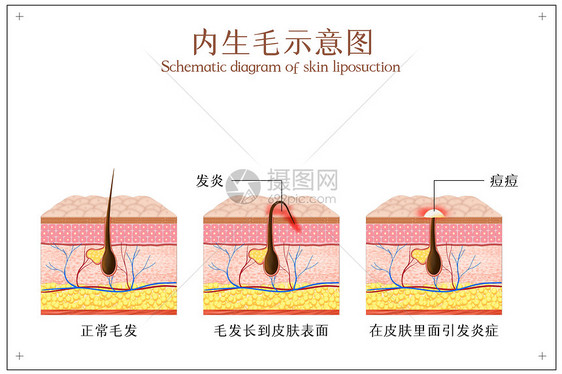 向内生长的毛发引发皮肤炎症示意图图片