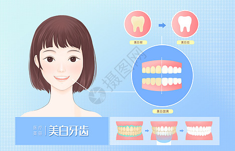 美白牙齿医疗插画图片