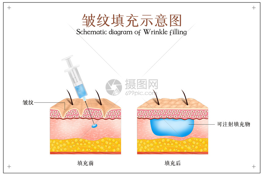 皮肤美容之皱纹填充图片