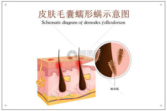 毛囊蠕形螨引发皮肤炎症图片