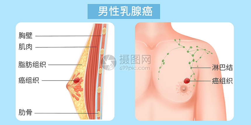 男性乳腺癌医疗插画图片