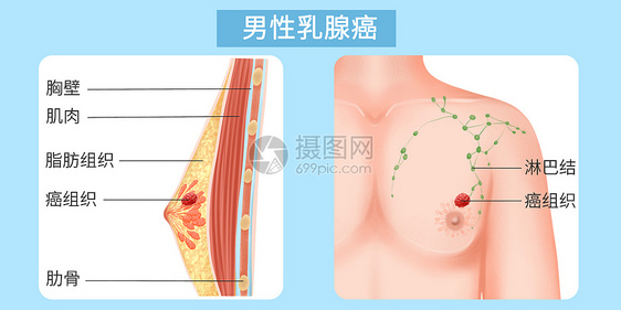 男性乳腺癌医疗插画图片