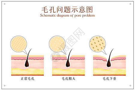 面部毛孔问题示意图背景图片